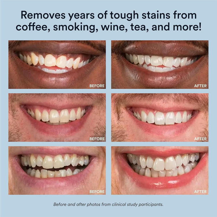 Teeth Whitening Kit, LED Accelerator Light, 35% Carbamide Peroxide Teeth Whitening Gel, 20+ Whitening Treatments, (2) 5Ml Whitening Gel Syringes, Whiten Teeth Faster